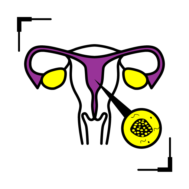 Graphic icon of a uterus annotated with cervical neck cancer location